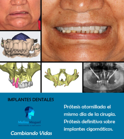 Implantes Dentales En Cdmx Cl Nica Dental Dentistetic