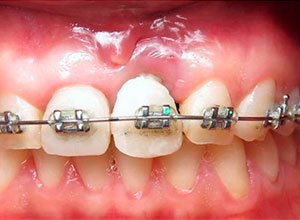 Distracción Alveolar Histogénica con Implante Dental