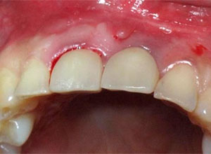 Distracción Alveolar Histogénica con Implante Dental