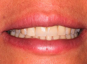 Distracción Alveolar Histogénica con Implante Dental