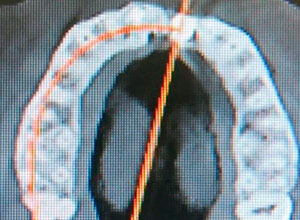 Distracción Alveolar Histogénica con Implante Dental