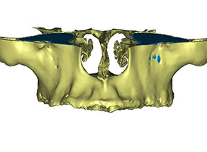 Rehabilitación Protesica sobre Implantes en Paciente con Enfermedad Periodontal Crónica