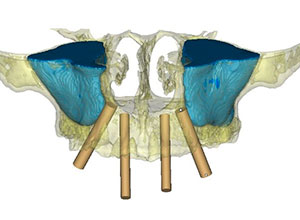 Rehabilitación Protesica sobre Implantes en Paciente con Enfermedad Periodontal Crónica