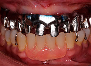 Rehabilitación Protesica sobre Implantes en Paciente con Enfermedad Periodontal Crónica