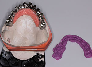 Rehabilitación Protesica sobre Implantes en Paciente con Enfermedad Periodontal Crónica