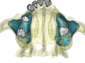Rehabilitación Protesica sobre Implantes en Paciente con Enfermedad Periodontal Crónica